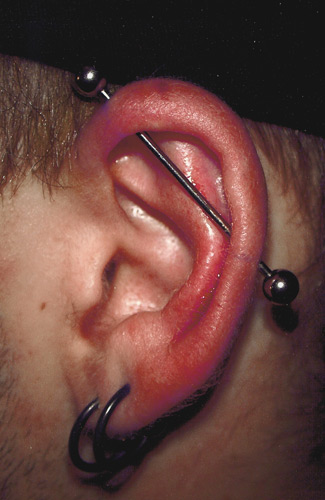 piercing infection. BE CAREFUL! ear piercing can